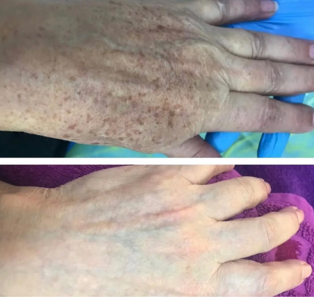 Фотоомоложение (кисти рук)