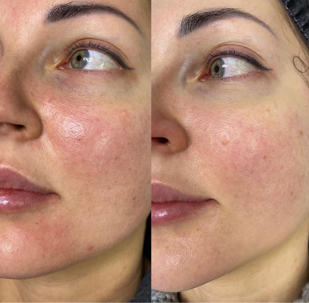 Фотоомоложение(лицо)