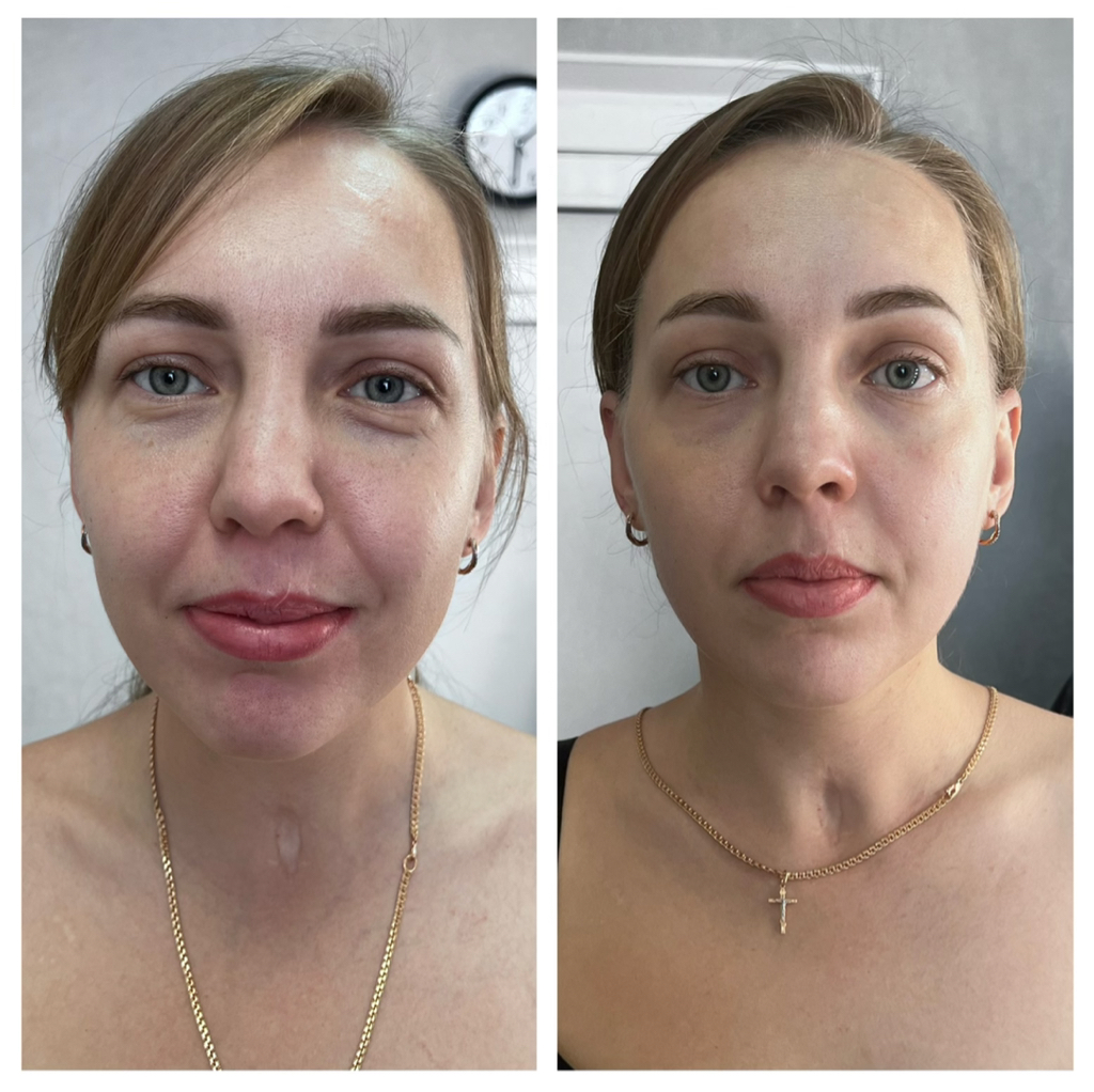 Массажный уход лица + Индиба лифтинг