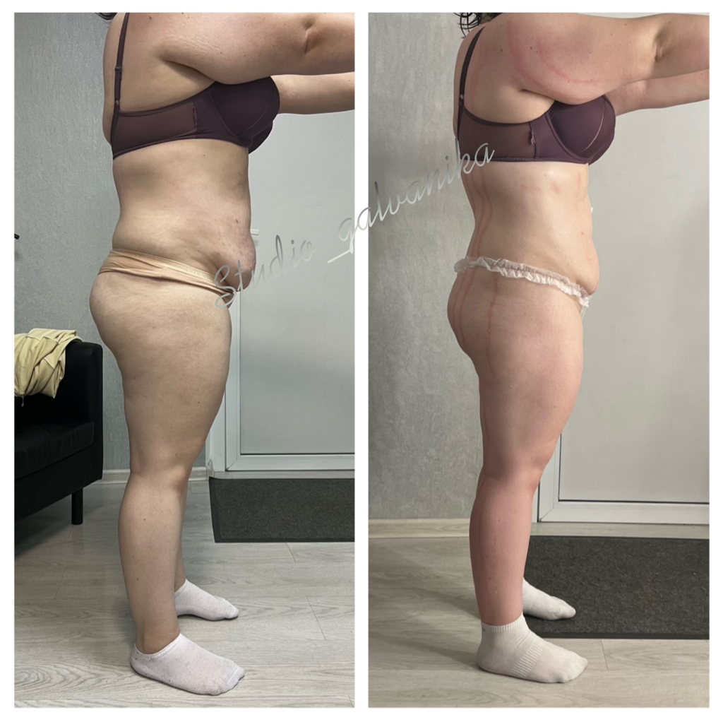 «Жиротоп»     

1. Микровейв + вакуум/вибро/пресс  2. Индиба + вакуум/вибро/пресс