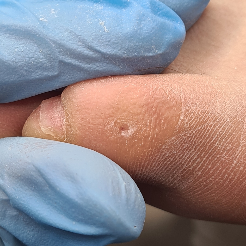 Удаление стержневой мозоли