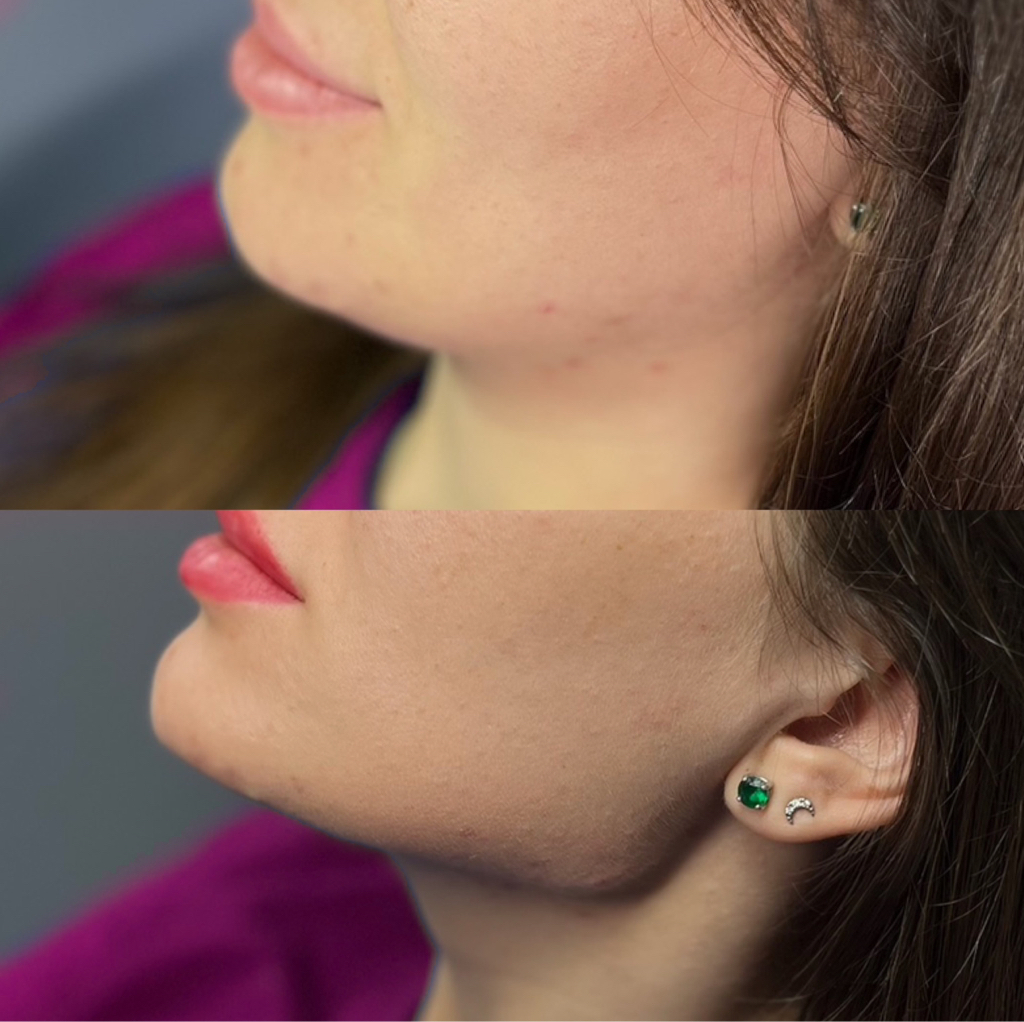 Контурная пластика лица (Носогубные складки,скулы,щечки,углы нижней челюсти,подбородок,профиль Джоли(углы+ подбородок)