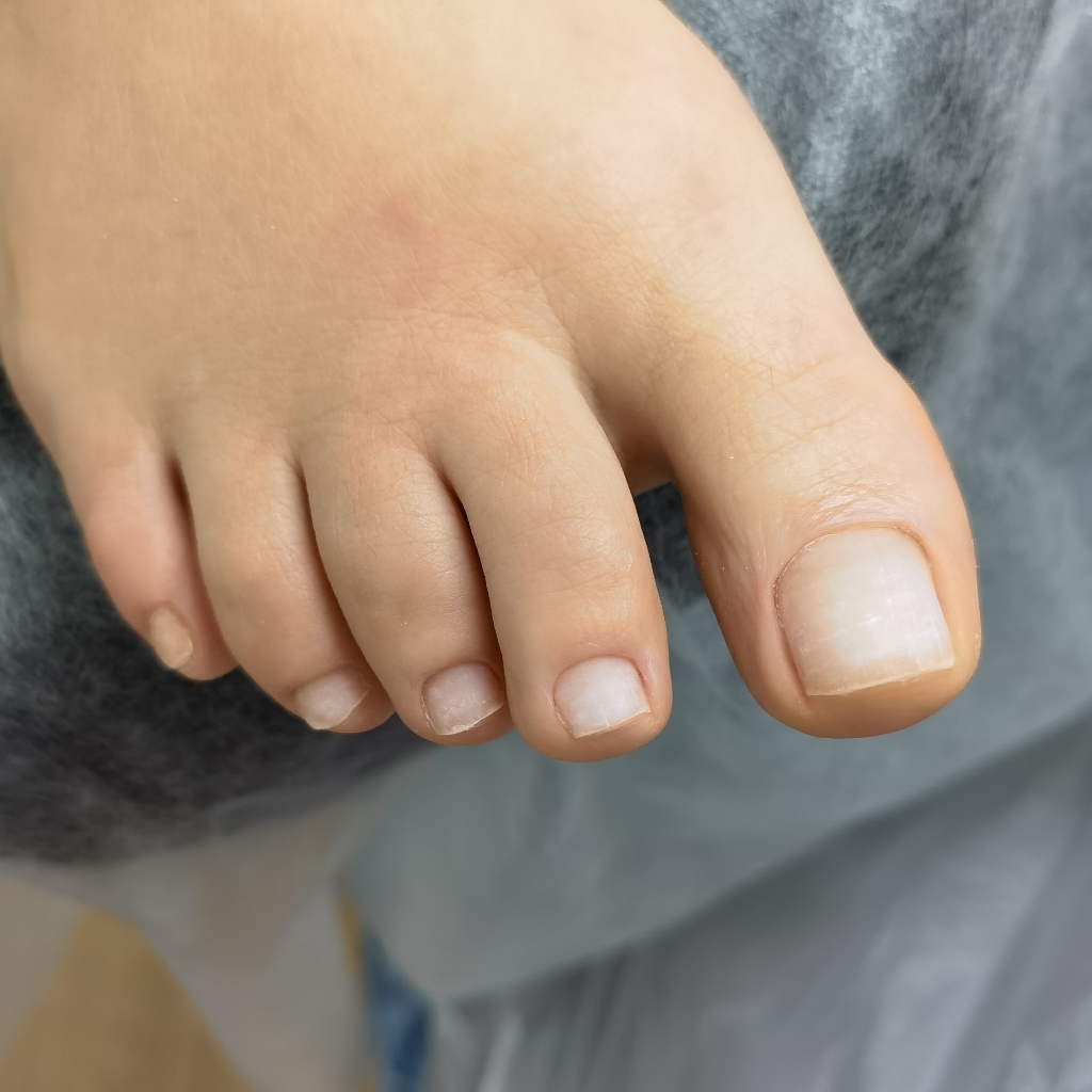 Обработка пальцев ног без покрытия