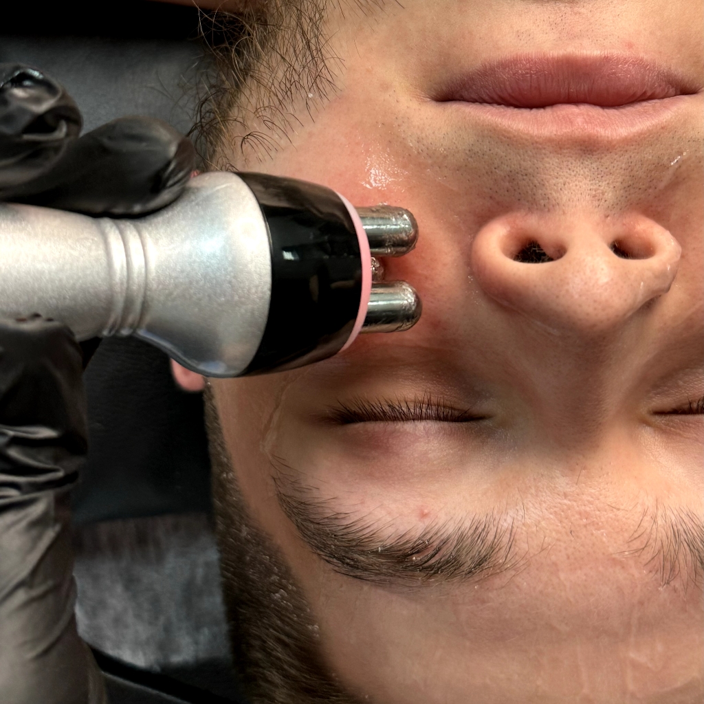 РФ лифтинг лица и тела (одна зона)