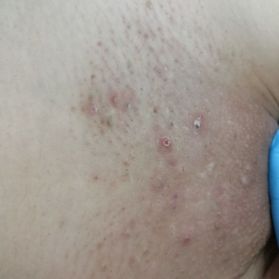 коррекция вросших волос