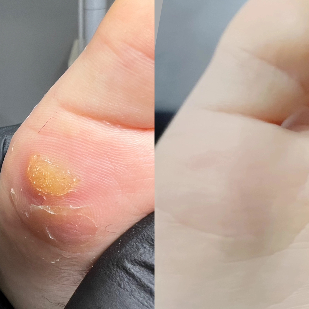 Удаление бородавки