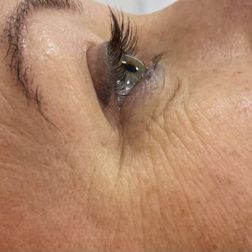 ХП + Насадки (Веки)круговая блефаро