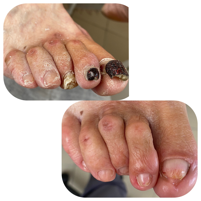 Педикюр медицинский