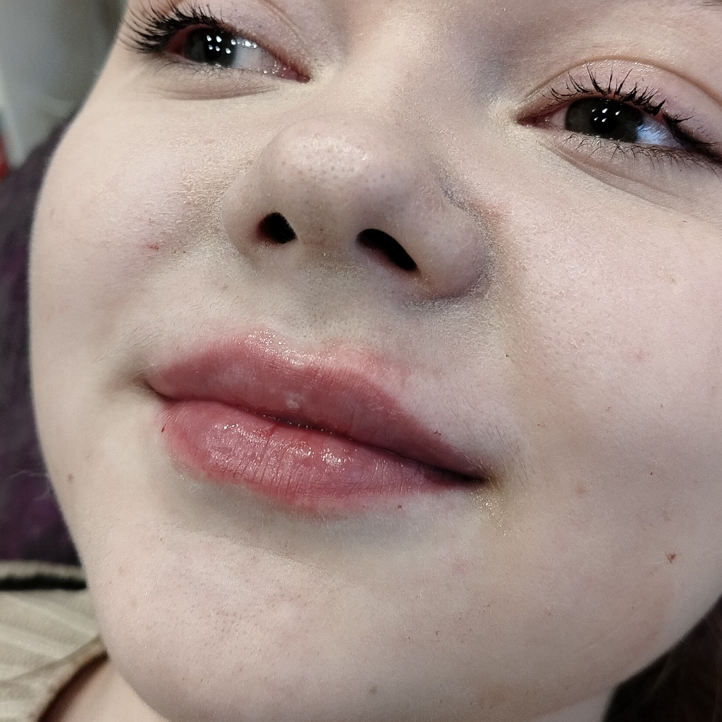 увеличение губ