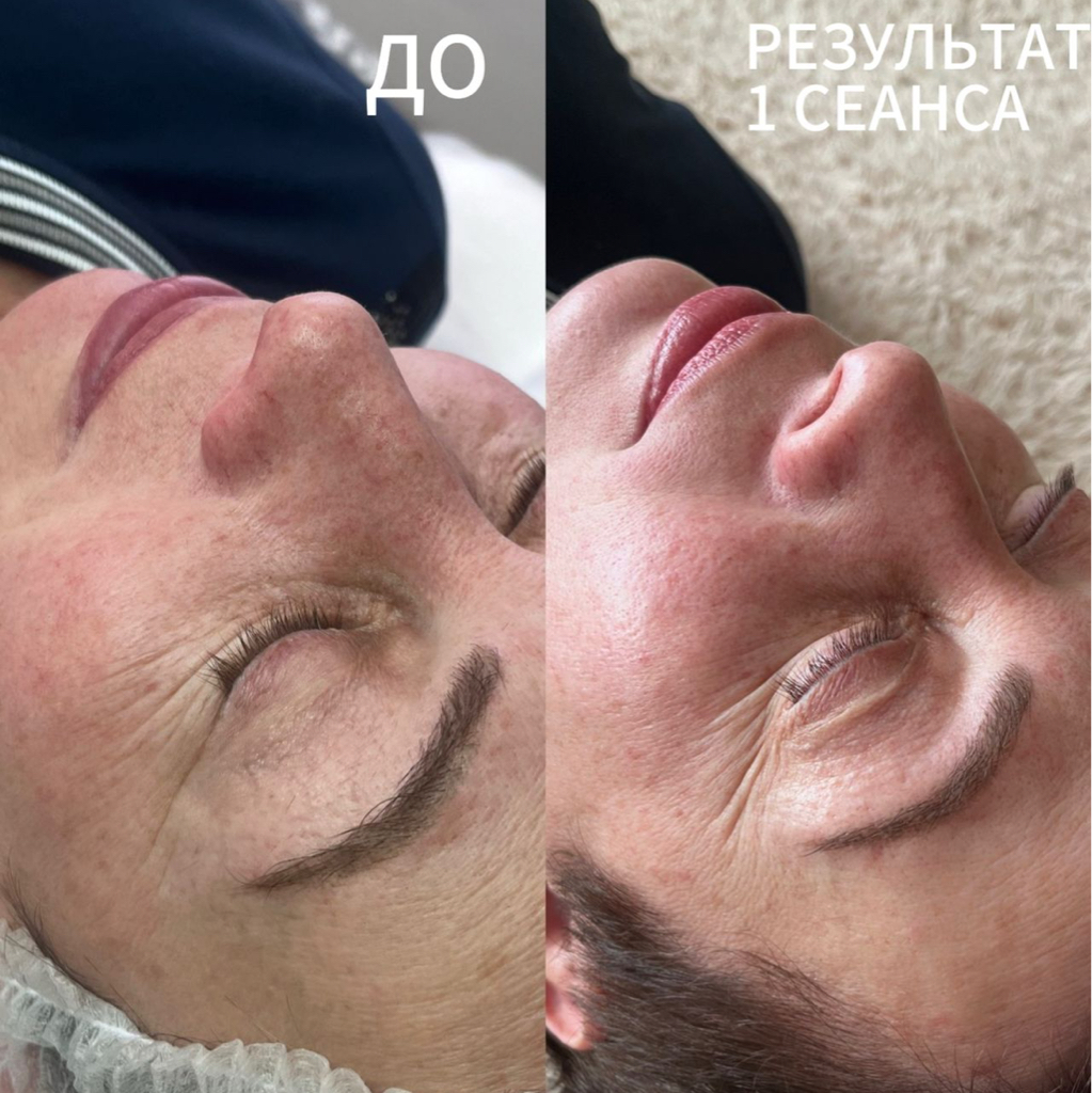 Лазерное диодное омоложение