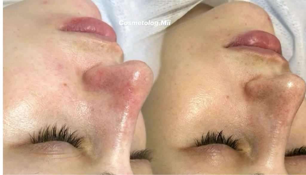 Чистка лица (атравматичная, УЗ, комбо)