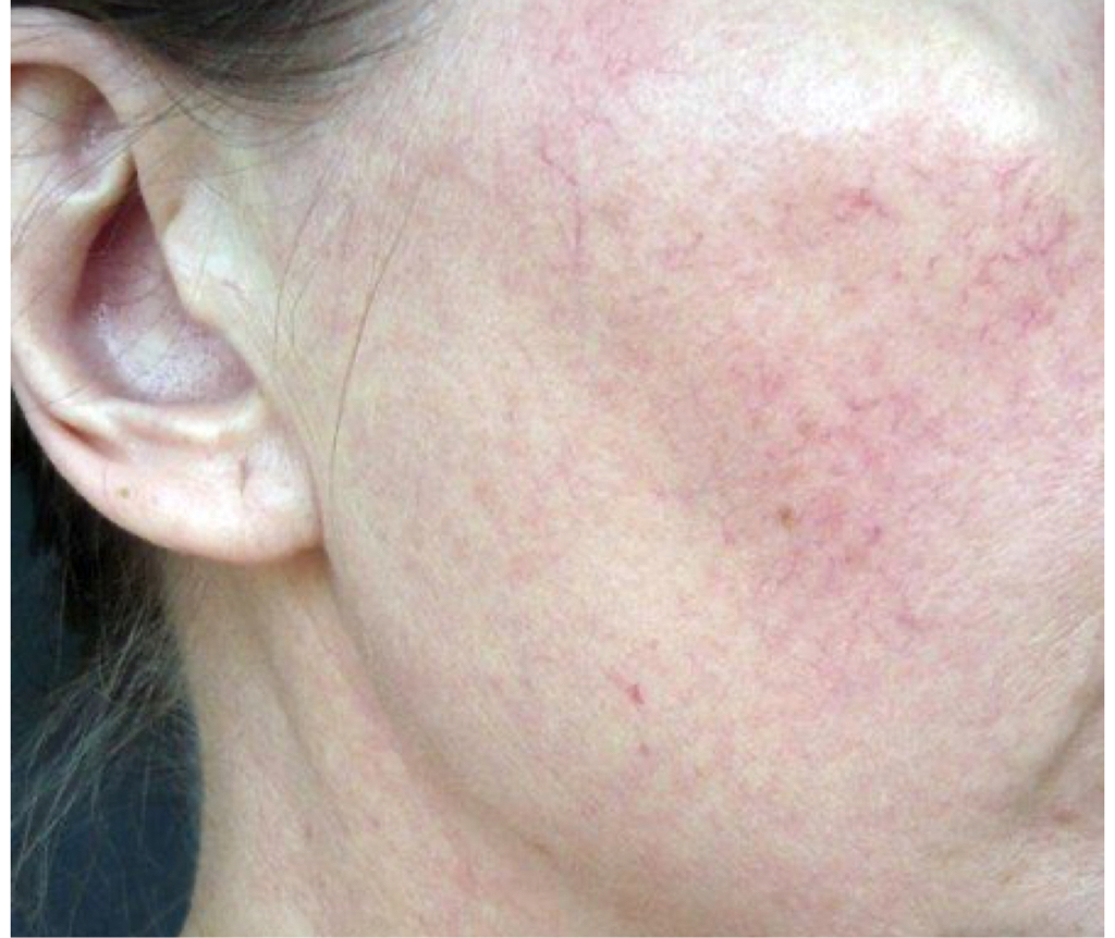 Эстетическая сосудистая терапия лица