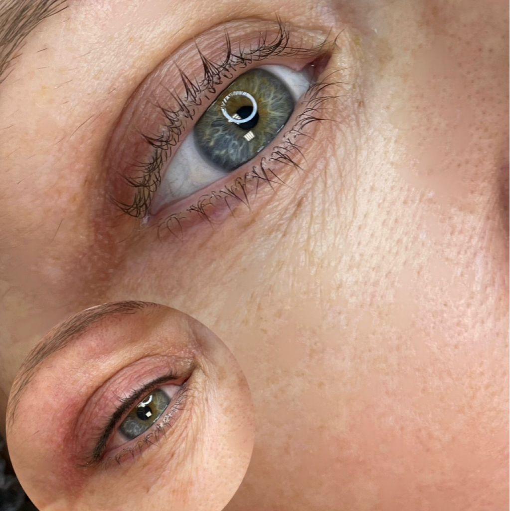 Коррекция межресничного пространства(через 30-45 дней после первичной)