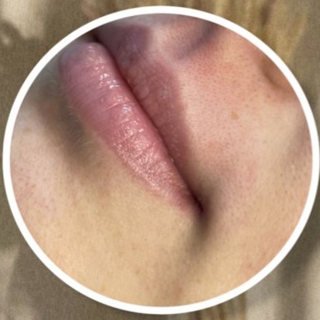 Депиляция над губой