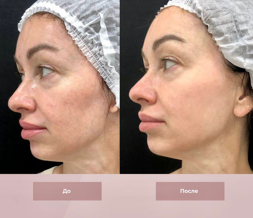 RENEW BTX PEEL   Ревитализирующий пилинг с эффектом лифтинга, увлажнения и сияния кожи. Mesaltera (Россия).