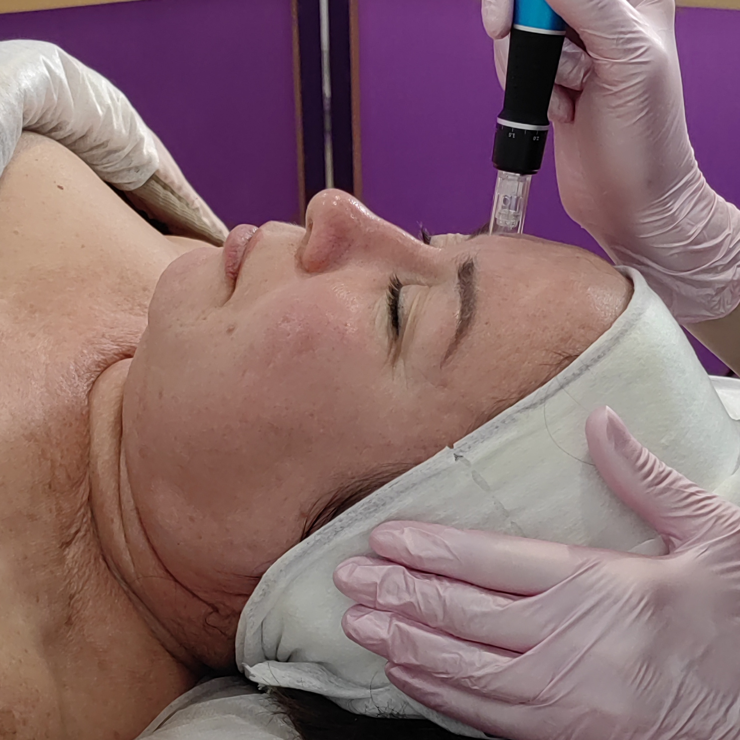 Микроигольчатый массаж