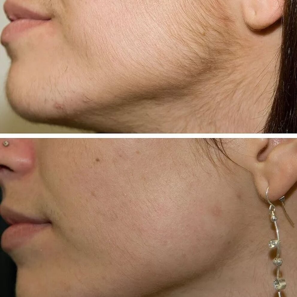 Депиляция щек