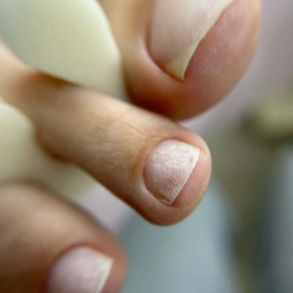 Снятие покрытия на ногах