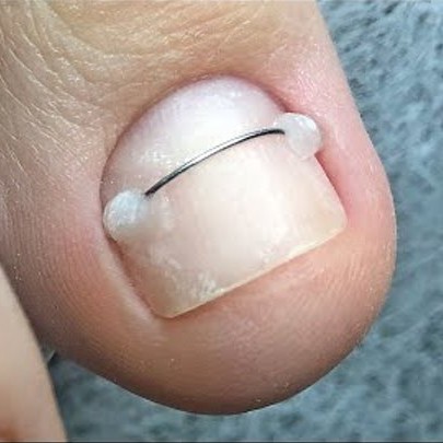 Снятие коррекционной системы