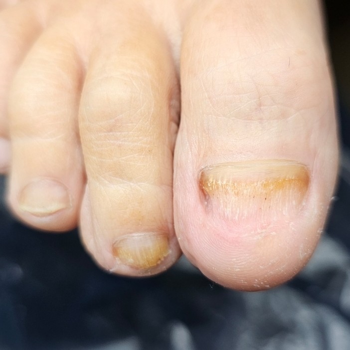 Обработка 1-го ногтя на ногах