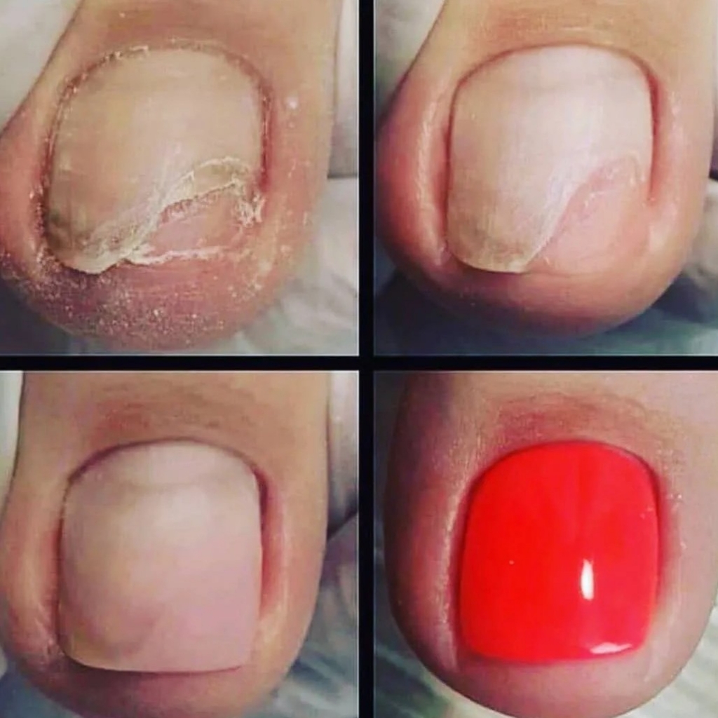 Протезирование 1-й ногтевой пластины