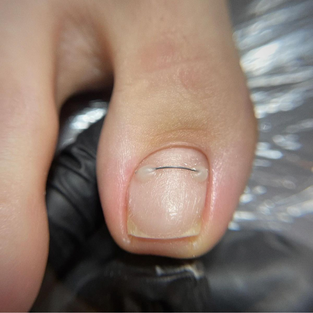 Установка кс (титановая нить, 1 ед.)