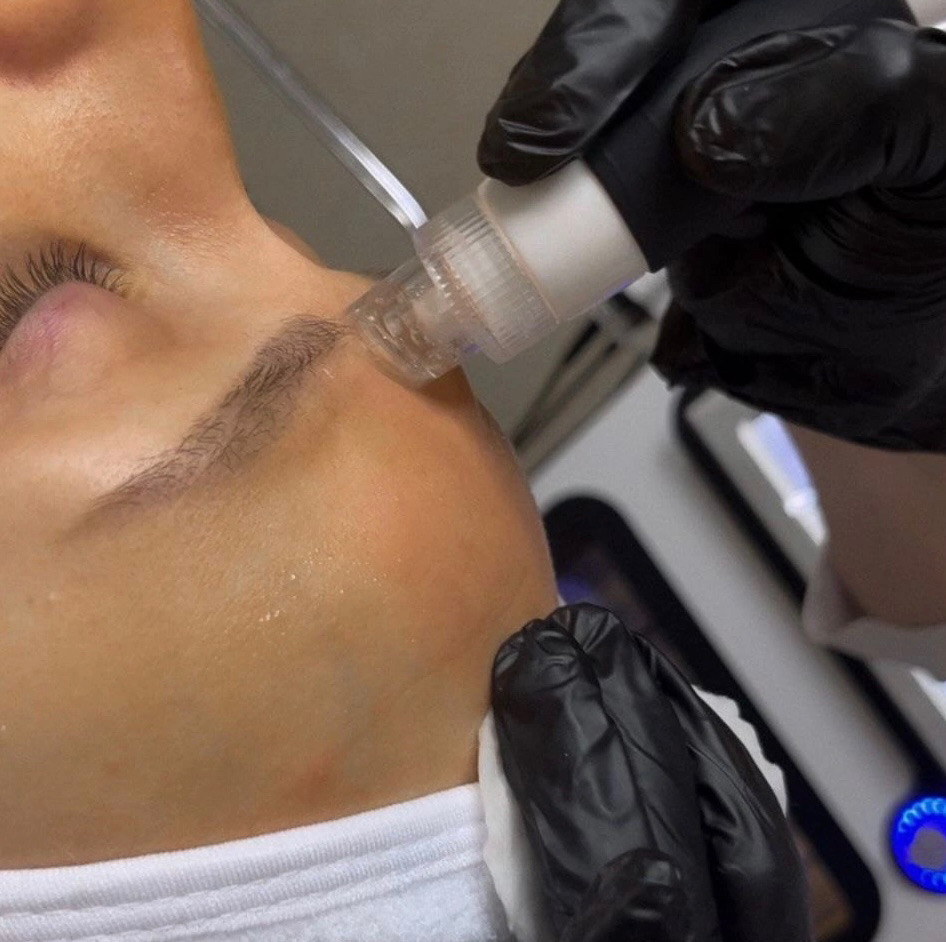 Гидропилинг (HYDRO FACIAL)