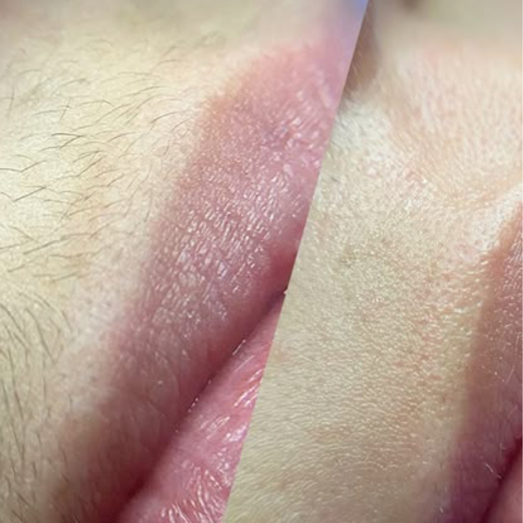 Восковая депиляция зоны над губой