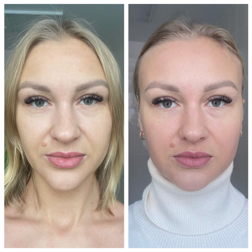 Лифтинг массаж лица