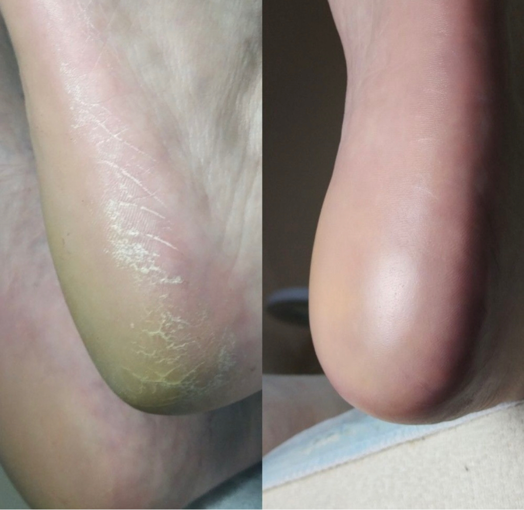 обработка стоп