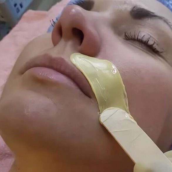 Депиляция лица