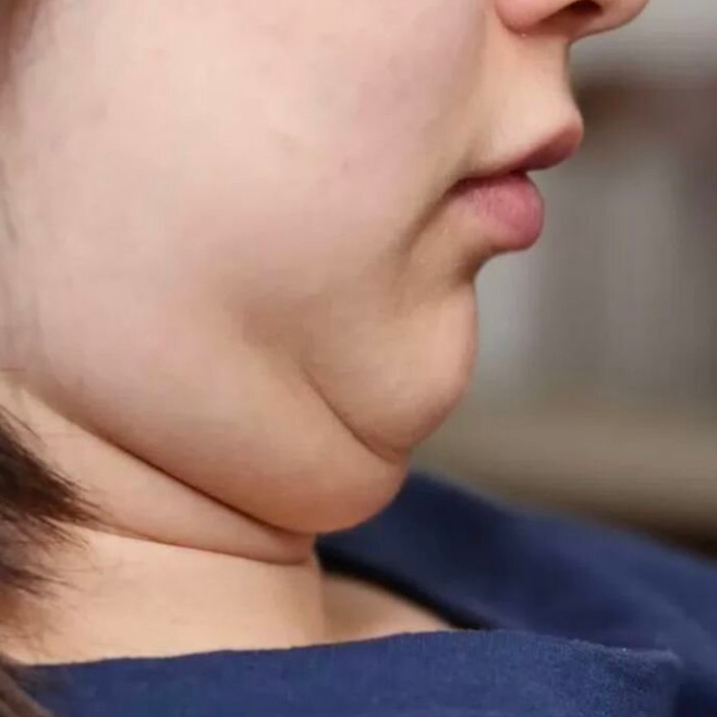 Криолиполиз подбородок