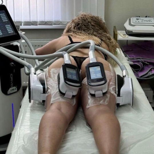 Криолиполиз (зона бока,галифе,спина,руки,внутренняя поверхность бедра