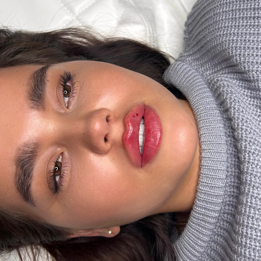 Увеличение губ корейским премиальным препаратом Elasty