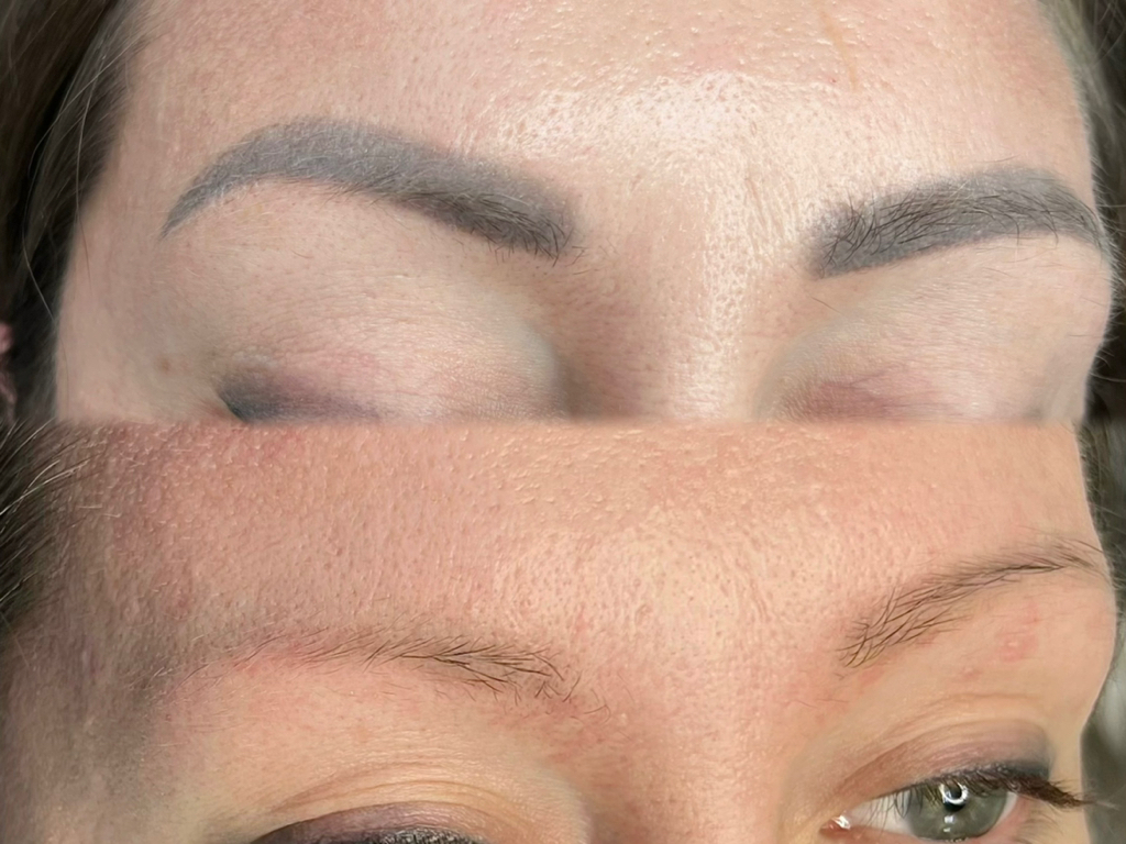 ПЕРВЫЙ ПРОБНЫЙ сеанс лазерного удаления татуажа(консультация)    

✅ГАРАНТИЯ💯 Результат заметен уже после 1 сеанса