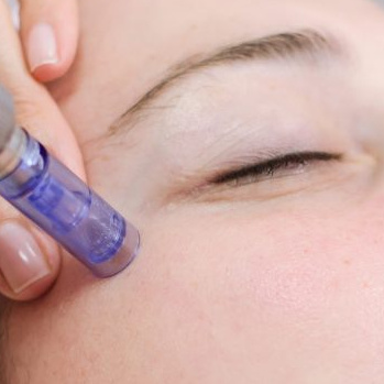 Мезотерапия