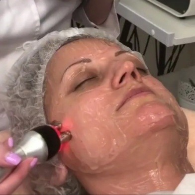 Рф лифтинг + пилинг + карбокситерапия