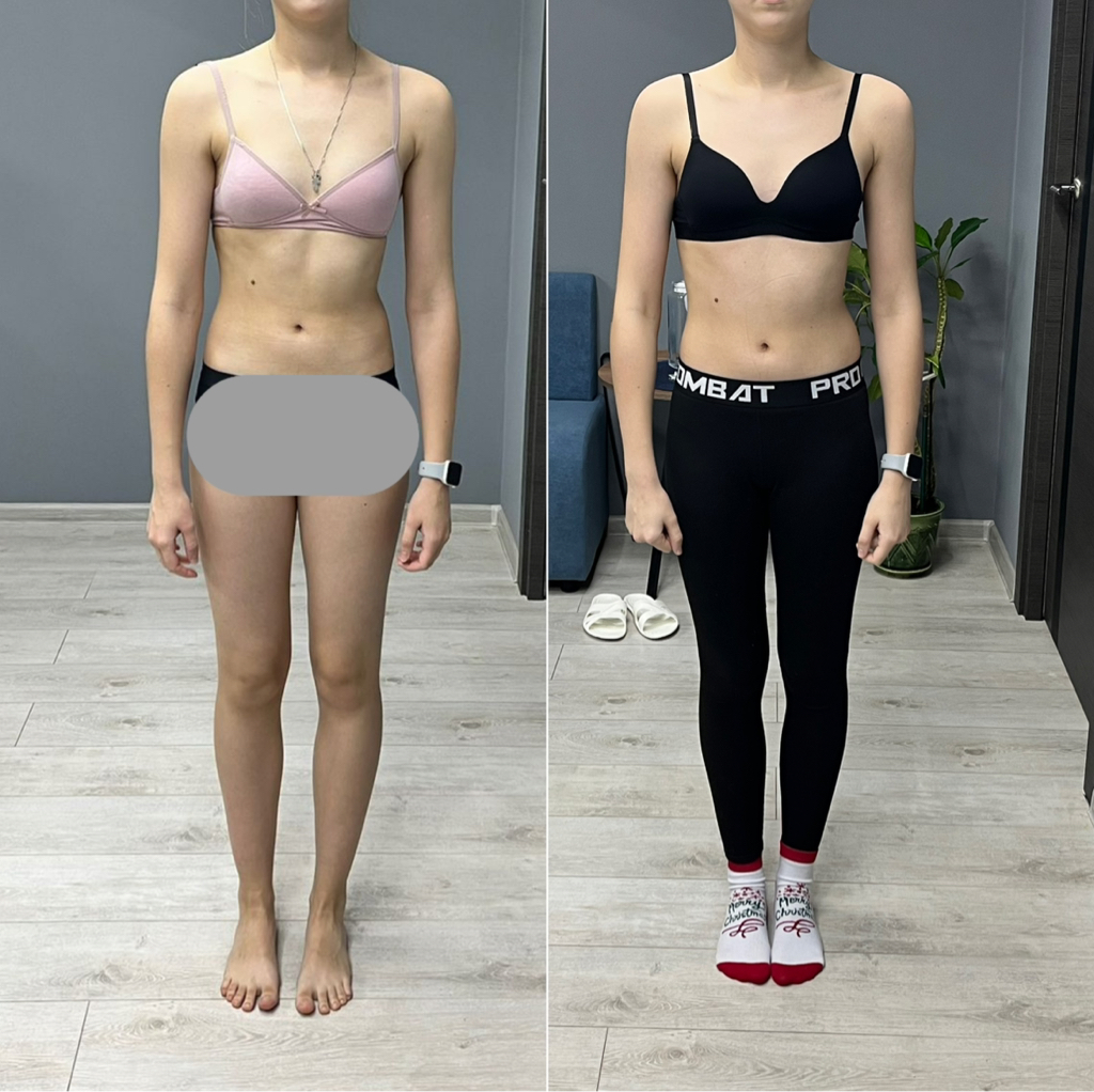 Функциональная коррекция  подростки 12-16 лет