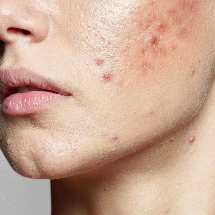 Лечение акне, постакне, рубцы