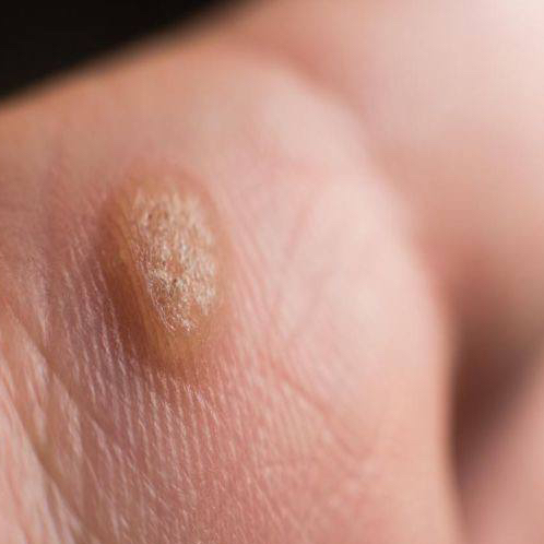 Удаление бородавок/папиллом/шипицы