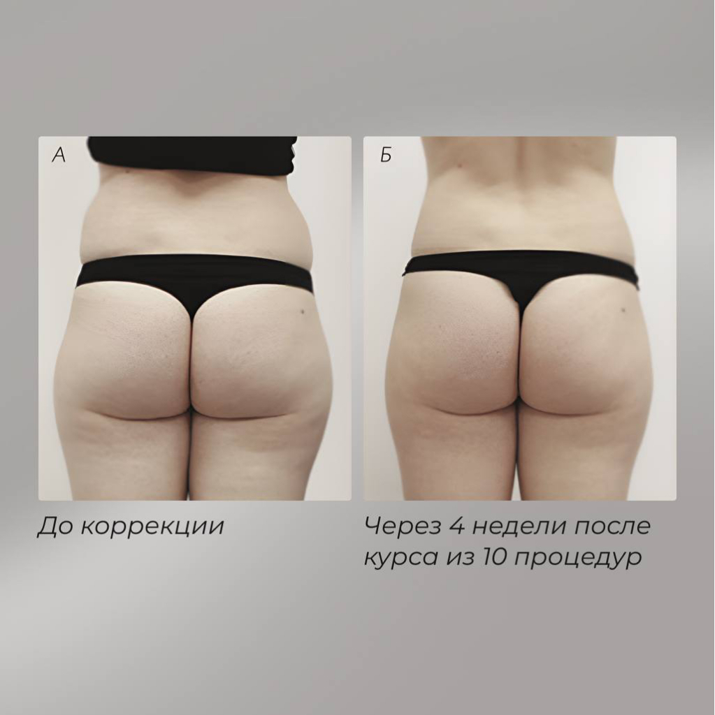 МЕЗОТЕРАПИЯ. Активный коктейль с мощным липолитическим, метаболическим и лимфодренажным действие - MPX. Лицо, тело.
5 мл