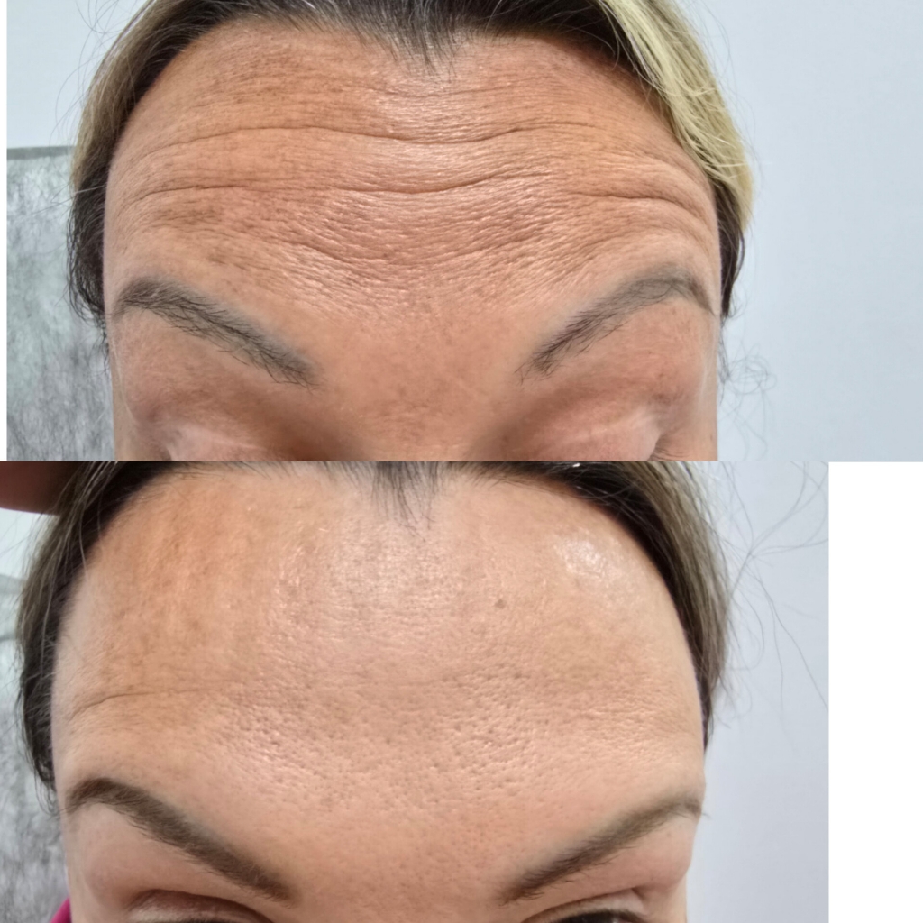 Ботокс Фул Фэйс