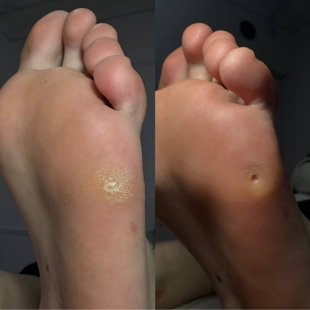 Обработка стержневой мозоли