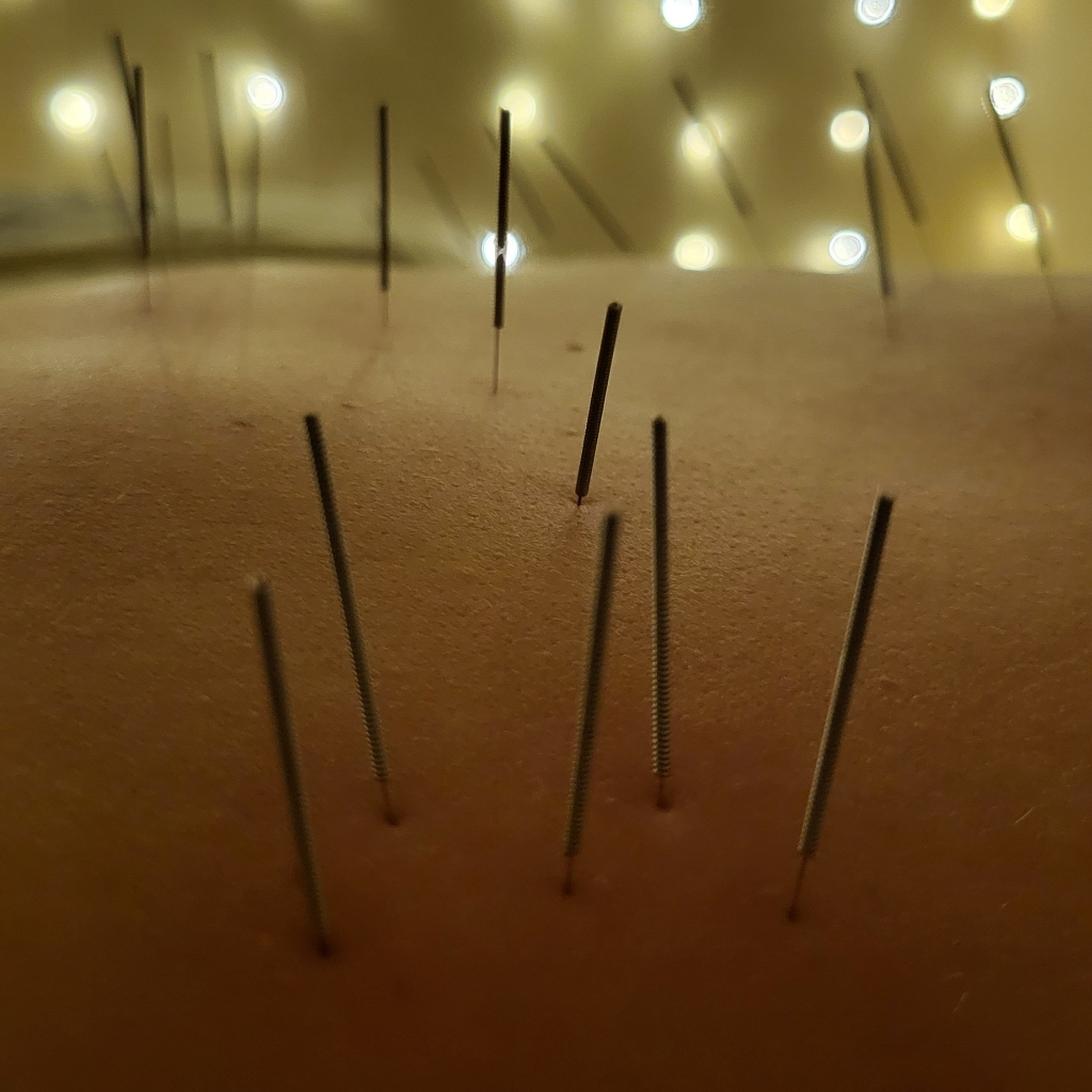 Иглорефлексотерапия