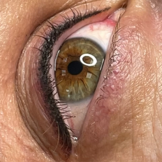 Межресничка