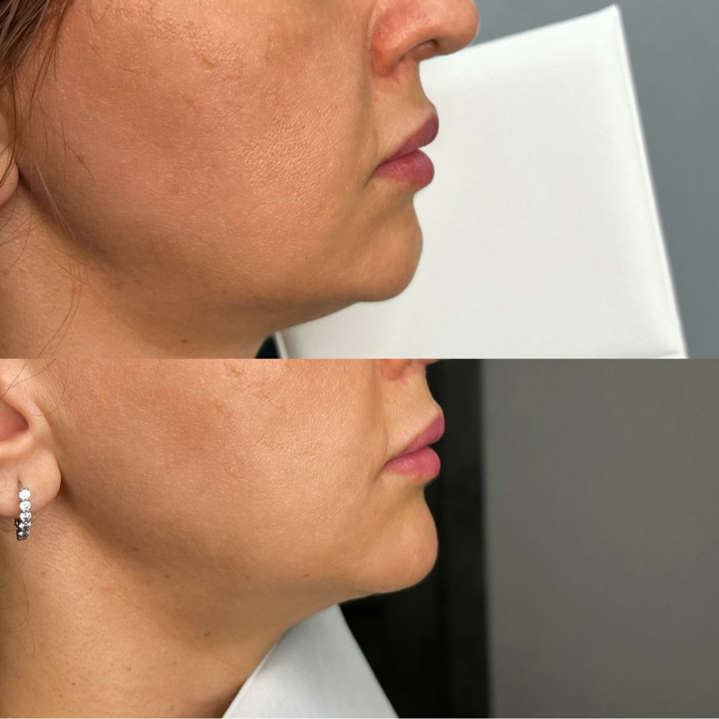 Контурная пластика подбородка