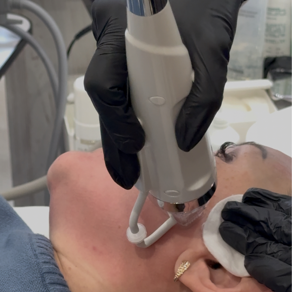 Микроигольчатый рф лифтинг лицо+шея (шея, нижняя треть лица, подбородок, щеки, лоб)