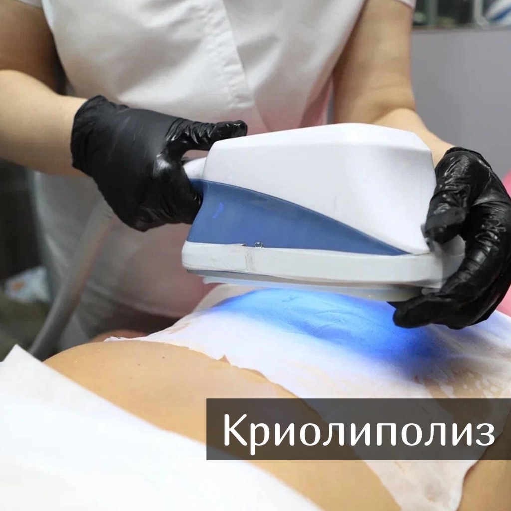 криолиполиз 2 зоны