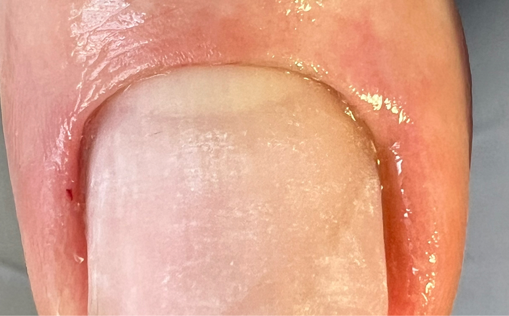 Протезирование