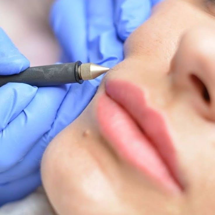 Электроэпиляция ЛИЦА